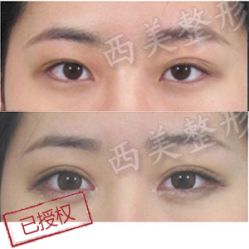 双眼皮效果图1-西美医疗美容门诊部