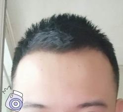 -大麦微针植发丨全国连锁