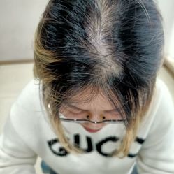 点击看大图 体验后-大麦微针植发丨全国连锁