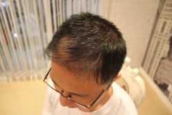 -大麦微针植发丨全国连锁