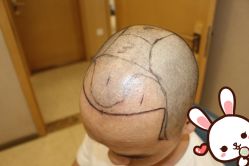 -大麦微针植发丨全国连锁