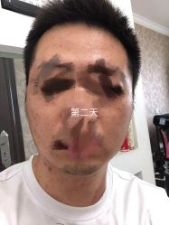 -爱莎扁平疣·汗管瘤·斑痣中心