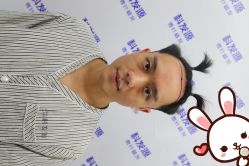 点击看大图 -大麦微针植发丨全国连锁