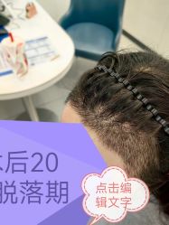 -大麦微针植发全国连锁