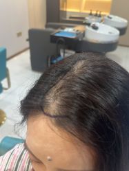 -碧莲盛不剃发植发