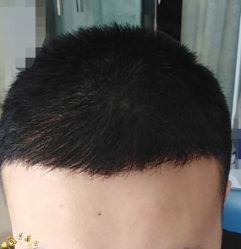 -大麦微针植发丨全国连锁