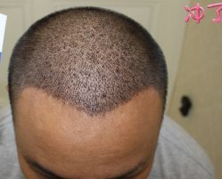 -大麦微针植发丨全国连锁