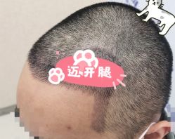 -大麦微针植发全国连锁