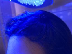 -碧莲盛·不剃发植发