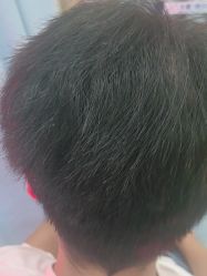 -大麦微针植发全国连锁