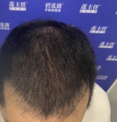 -碧莲盛·不剃发植发