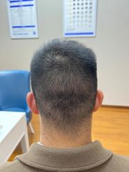 -大麦微针植发全国连锁