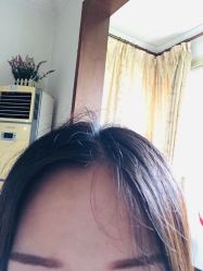 -碧莲盛·不剃发植发