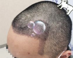 -大麦微针植发全国连锁