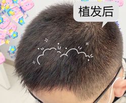 -大麦微针植发全国连锁