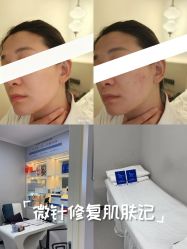 -蕾特恩专业祛痘国际连锁