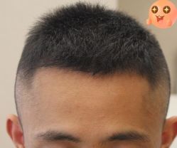 -大麦微针植发丨全国连锁