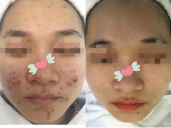 体验前-瓷肌博士·祛痘科技美肤