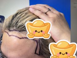 -碧莲盛·不剃发植发