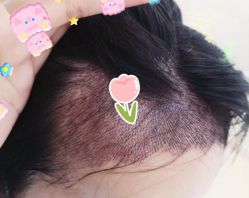 -大麦微针植发全国连锁