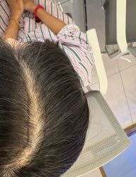 -碧莲盛不剃发植发