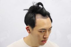 -大麦微针植发丨全国连锁