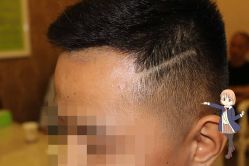 -大麦微针植发丨全国连锁