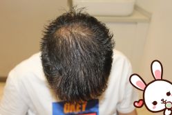 -大麦微针植发丨全国连锁