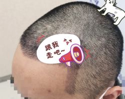 -大麦微针植发全国连锁