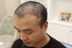 点击看大图 -大麦微针植发丨全国连锁