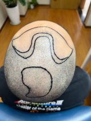 体验前-大麦微针植发全国连锁