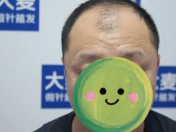 点击看大图 -大麦微针植发丨全国连锁