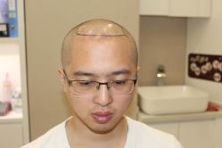 点击看大图 -大麦微针植发丨全国连锁