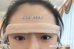 体验后-沈阳名流美容医院