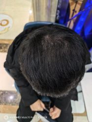 -碧莲盛·不剃发植发