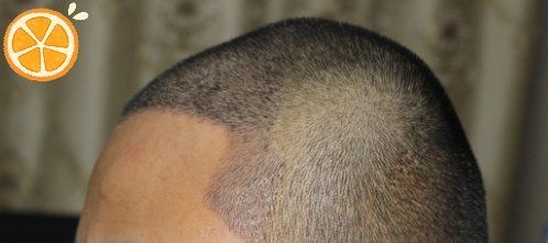 -大麦微针植发丨全国连锁