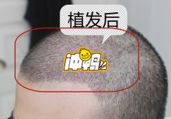 -大麦微针植发全国连锁