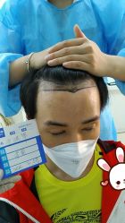 -大麦微针植发丨全国连锁