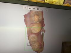 -上海仁爱医院口腔科 · 种植