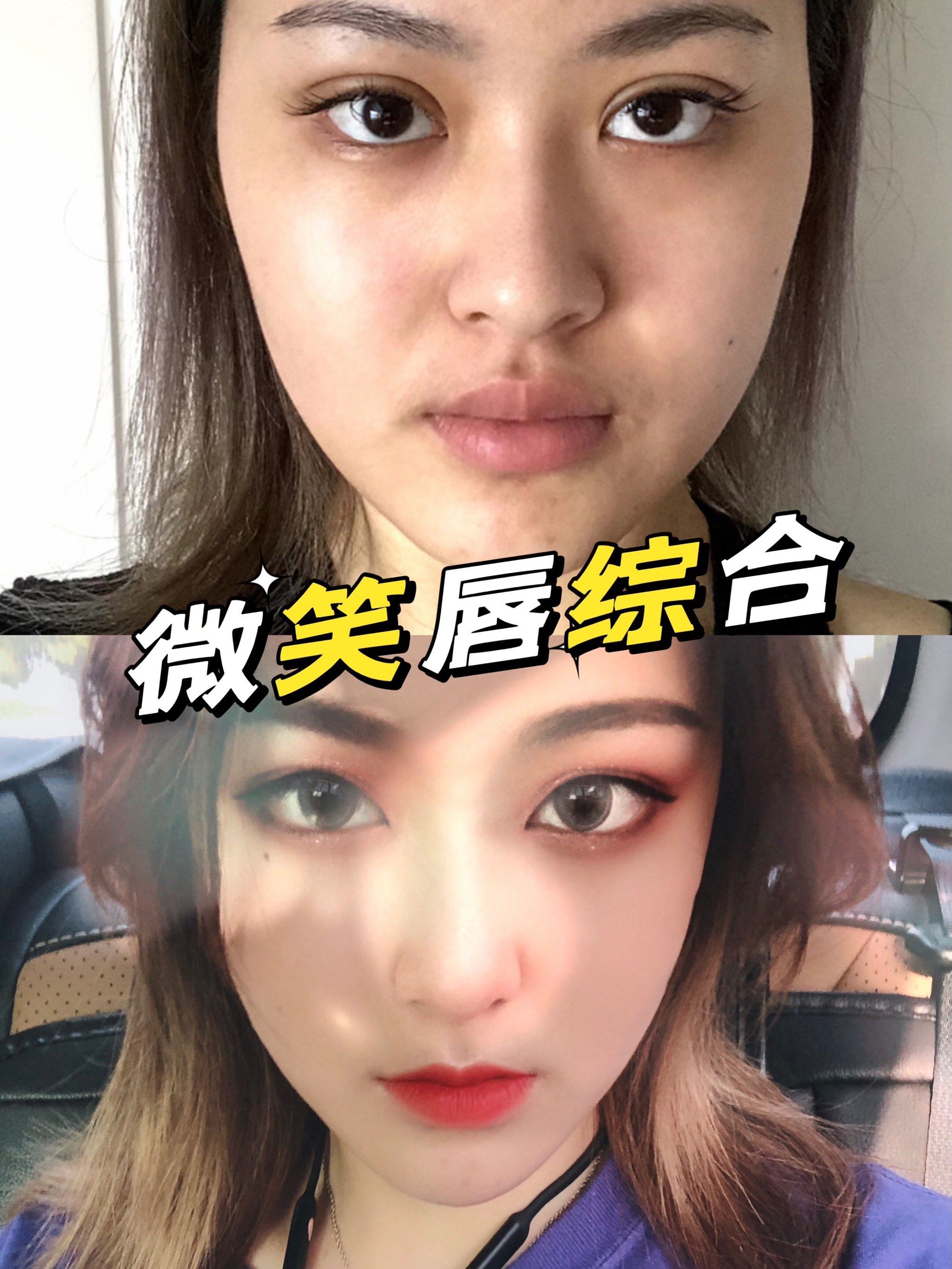 今日来稿,微笑唇综合