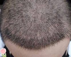 -大麦微针植发丨全国连锁