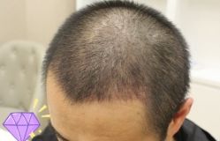 -大麦微针植发丨全国连锁