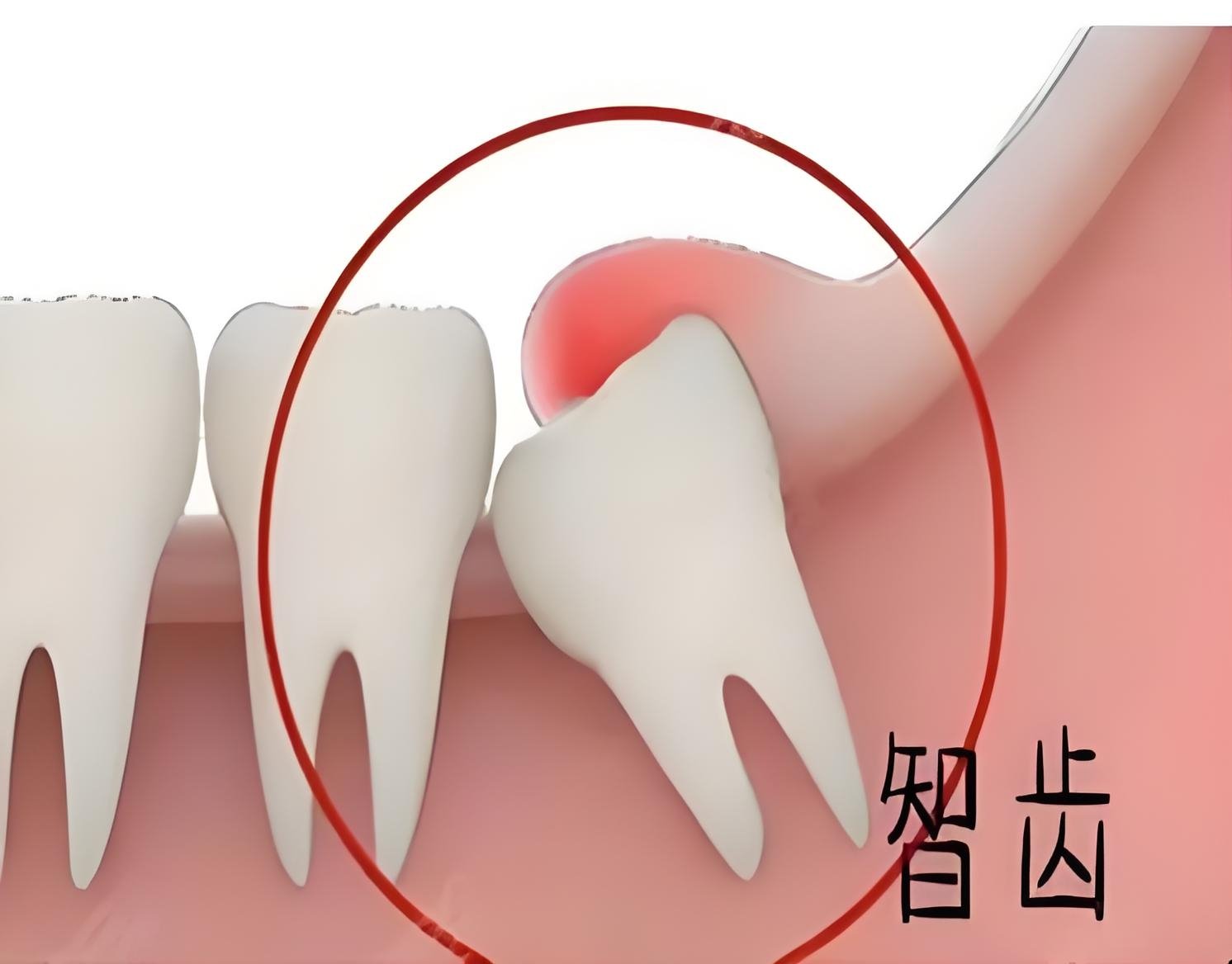 智齿位置不正图片