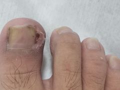 -世龙世家灰指甲鸡眼脚气甲沟炎跖疣护理(通州店)