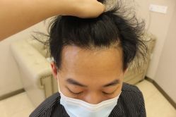 -大麦微针植发丨全国连锁