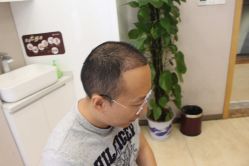 -大麦微针植发丨全国连锁