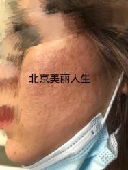 -美丽人生祛斑扁平疣汗管瘤中心