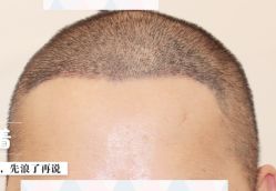 -大麦微针植发全国连锁