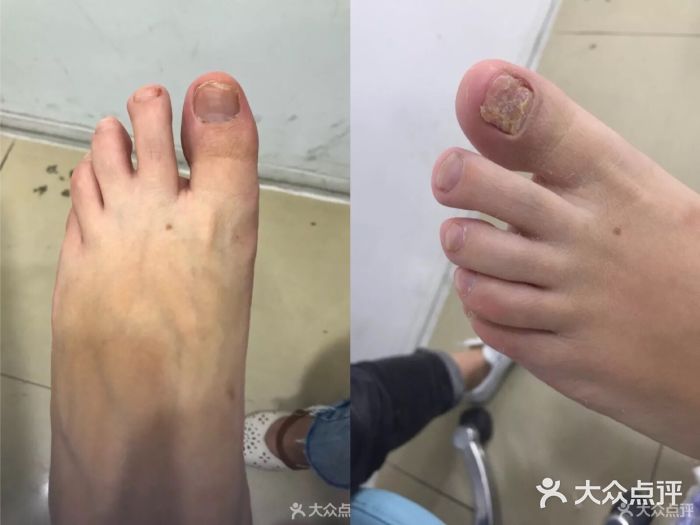 世龙世家灰指甲·甲沟炎·跖疣护理·修脚(东江湾路店)图片