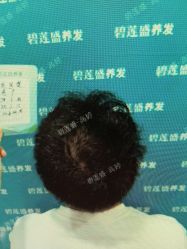 -碧莲盛·不剃发植发